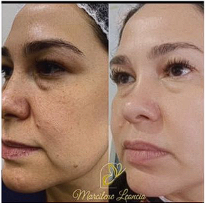 Resultado de tratamento facial - Antes e Depois