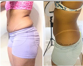 Resultado de tratamento corporal - Antes e Depois