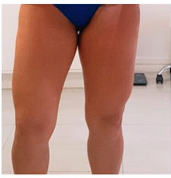 Resultado de tratamento corporal - Antes e Depois